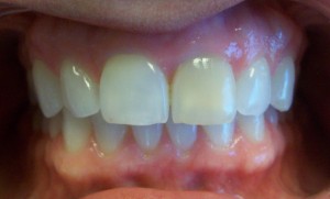 The dark front tooth