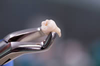 extractions-wisdom-teeth