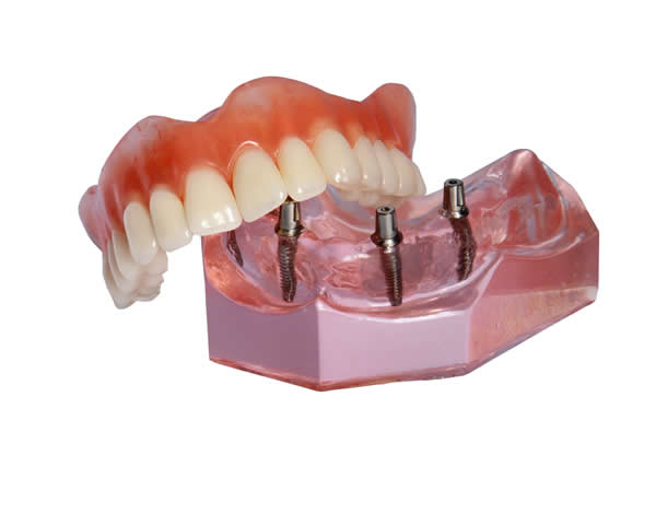 dental-implants-for-dentures-model