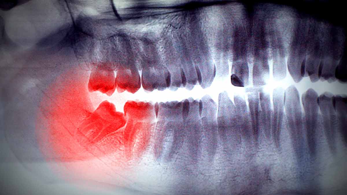 wisdom-teeth-extraction