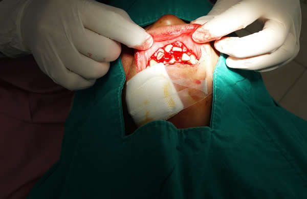 broken-teeth-emergency-accident