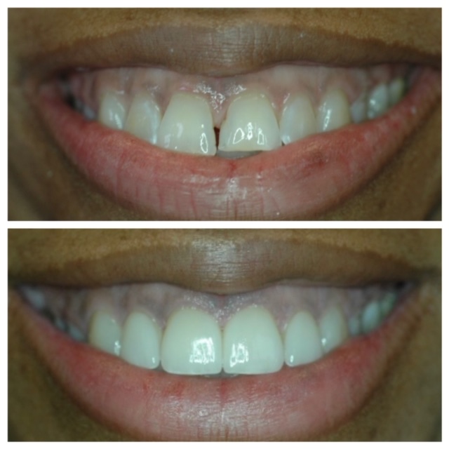 before-after-porcelain-veneers-1