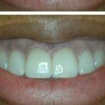 porcelain-veneers-1215-f
