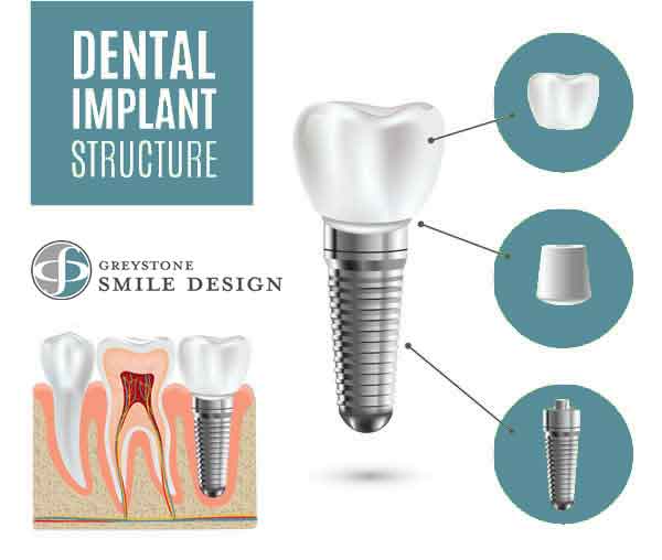 what-is-a-dental-implant