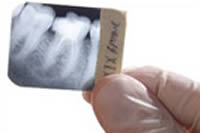 root-canal