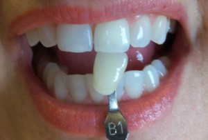 internal-bleaching-dark-tooth