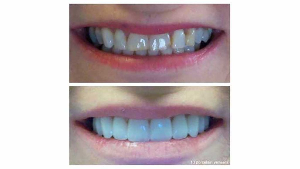 10-porcelain-veneers-youthful-appearance-f