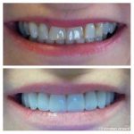 10-porcelain-veneers-youthful-appearance-f