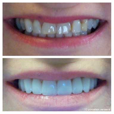 10-porcelain-veneers-youthful-appearance
