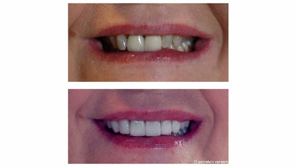 2-front-crowns-replaced-8-veneers-f