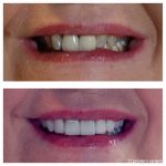 2-front-crowns-replaced-8-veneers-f