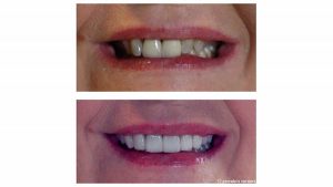 2-front-crowns-replaced-8-veneers-f