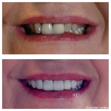 2-front-crowns-replaced-8-veneers