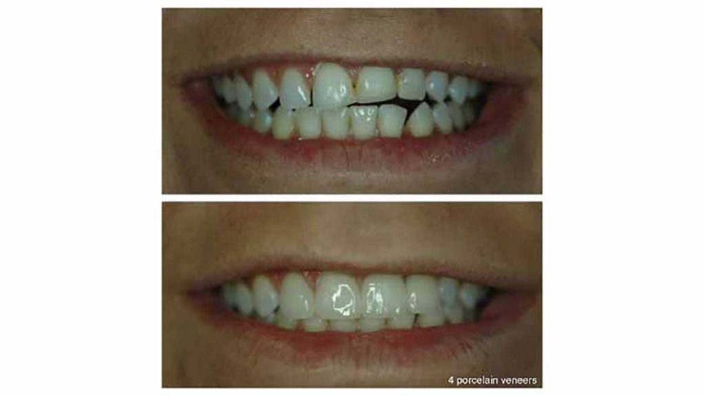 4-porcelain-veneers-leveling-front-teeth-f
