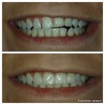 4-porcelain-veneers-leveling-front-teeth-f