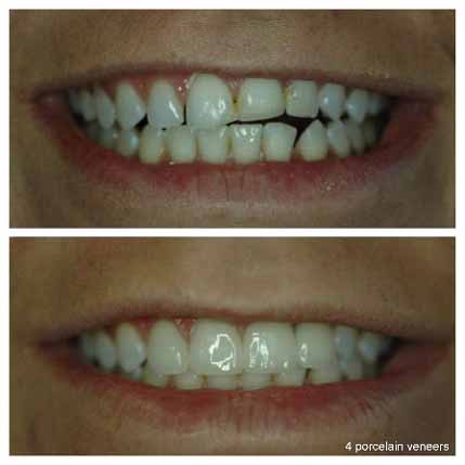 4-porcelain-veneers-leveling-front-teeth