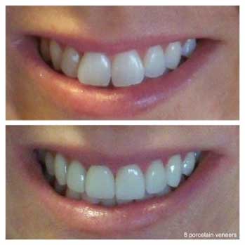 8-porcelain-veneers-align-upper-teeth