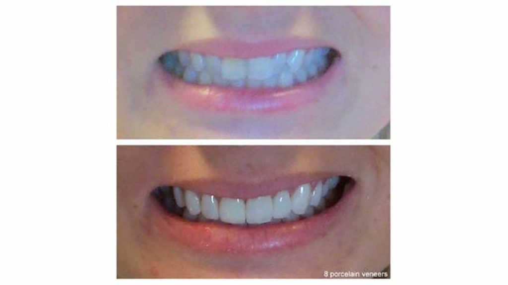 8-porcelain-veneers-f