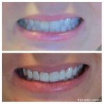 8-porcelain-veneers-f