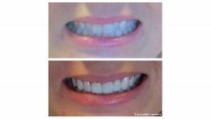 8-porcelain-veneers-f