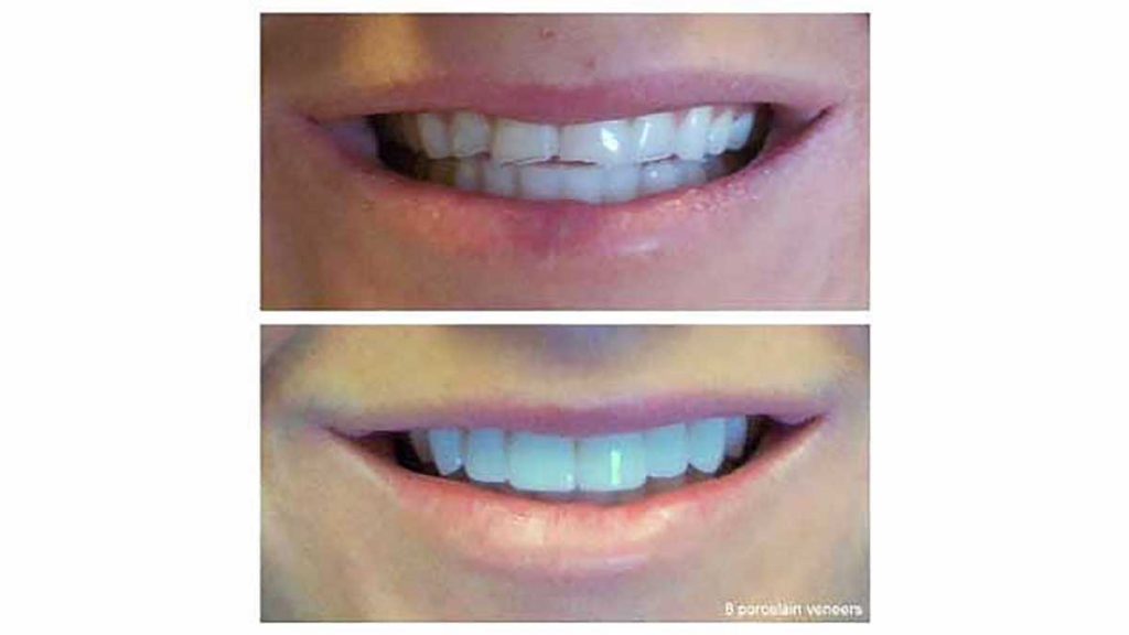 8-veneers-correct-chips-f