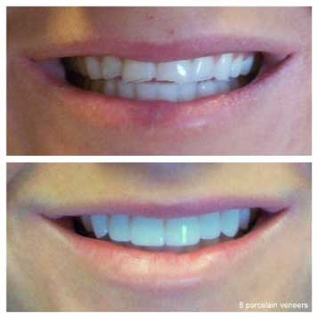 8-veneers-correct-chips