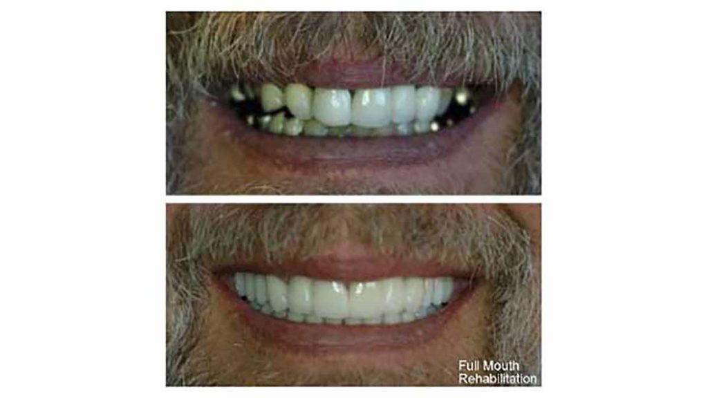 Full-mouth-rehab-f
