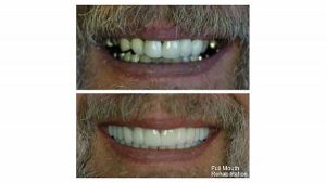 Full-mouth-rehab-f