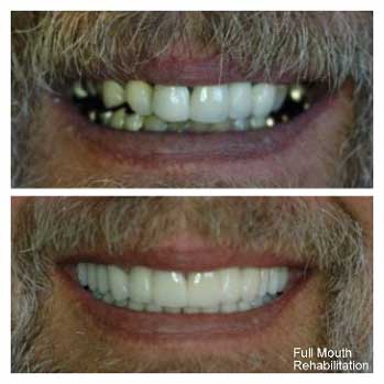 Full-mouth-rehab