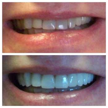 crowns-veneers-and-bridge-transform-smile