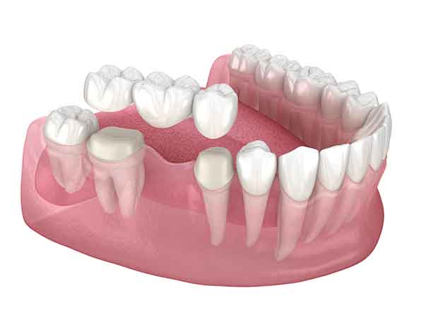 dental-bridge