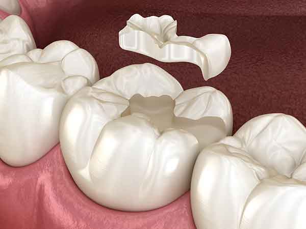 dental-inlays-onlays