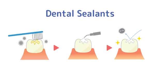 dental-sealants