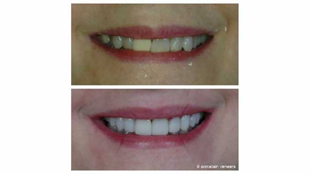 discolored-crown-9-veneers-f