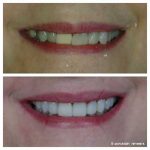 discolored-crown-9-veneers-f
