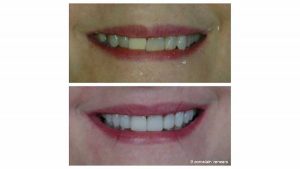 discolored-crown-9-veneers-f