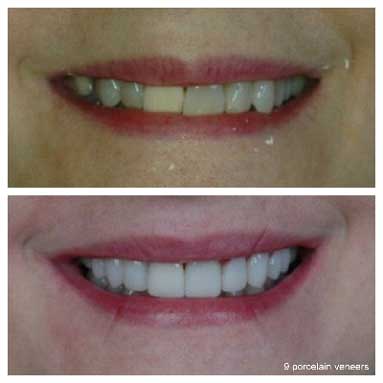 discolored-crown-9-veneers