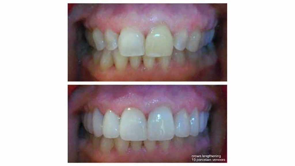 gum-lift-10-veneers-f