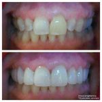gum-lift-10-veneers-f