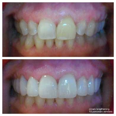 gum-lift-10-veneers