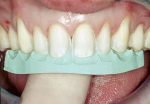 teeth-mold-for-veneers