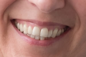 virtual-smile-makeover-closeup