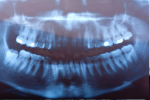 virtual-smile-makeover-x-rays