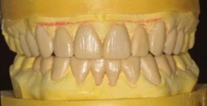 wax-template-for-veneers