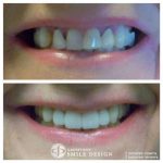 2-porcelain-veneers-front-teeth-before-after-featured