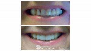 2-porcelain-veneers-front-teeth-before-after-featured