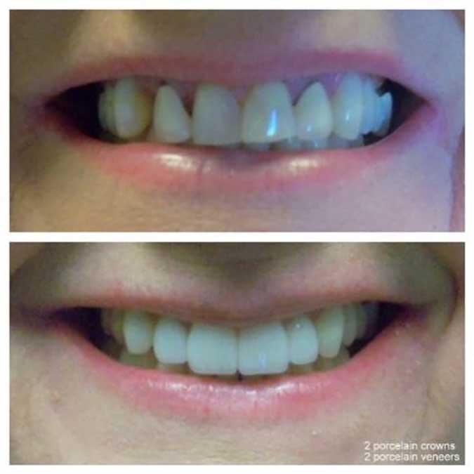 before-after-2-porcelain-veneers-front-teeth