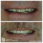 4-porcelain-veneers-before-after-featured