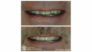 4-porcelain-veneers-before-after-featured