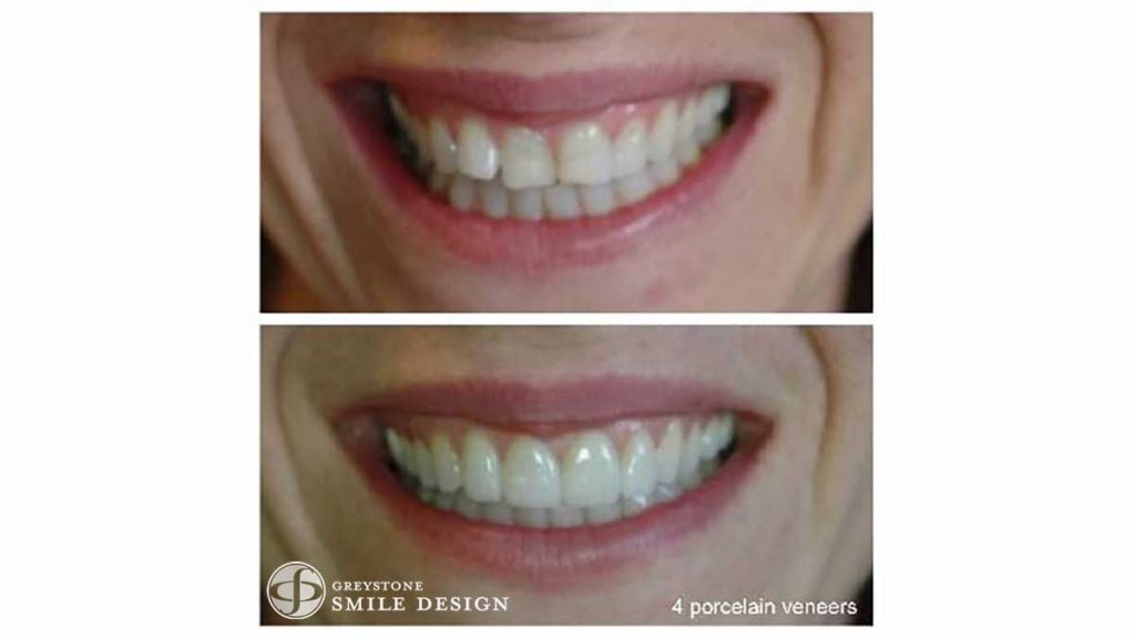 4-porcelain-veneers-woman-before-after-featured